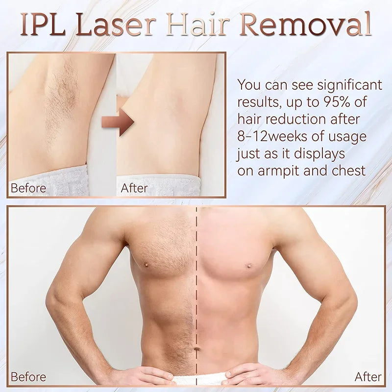Permanent Laser Epilierer