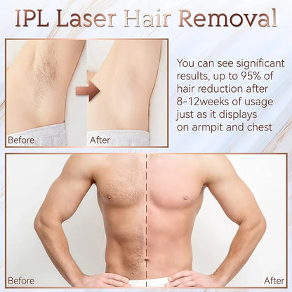 Permanent Laser Epilierer
